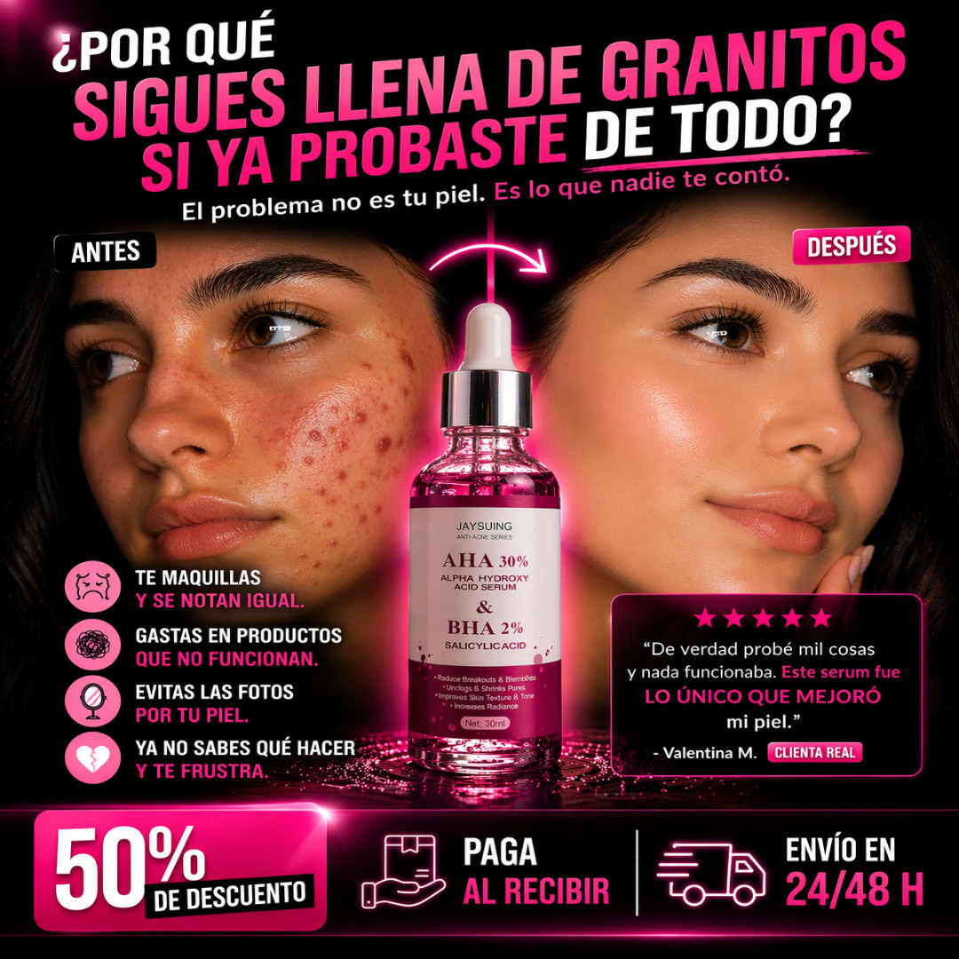 El acné que siempre vuelve… acá esta la solución