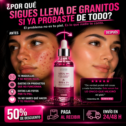 El acné que siempre vuelve… acá esta la solución