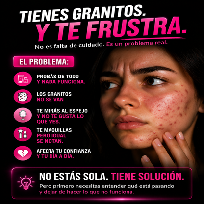 El acné que siempre vuelve… acá esta la solución